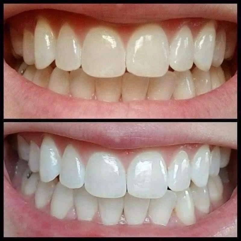 Teeth Whitening – Suitable for Ages 6+