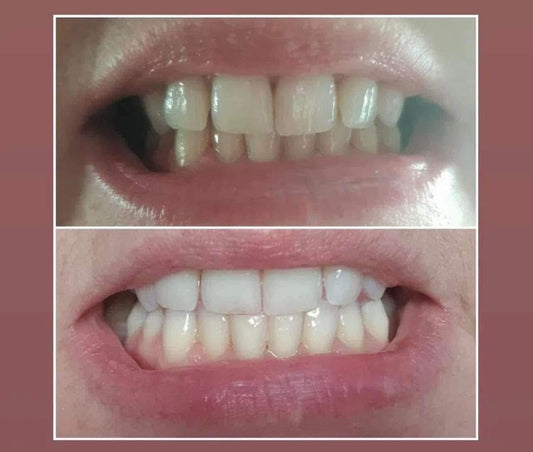 Teeth Whitening – Suitable for Ages 6+
