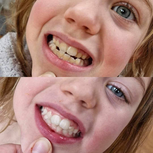 Teeth Whitening – Suitable for Ages 6+