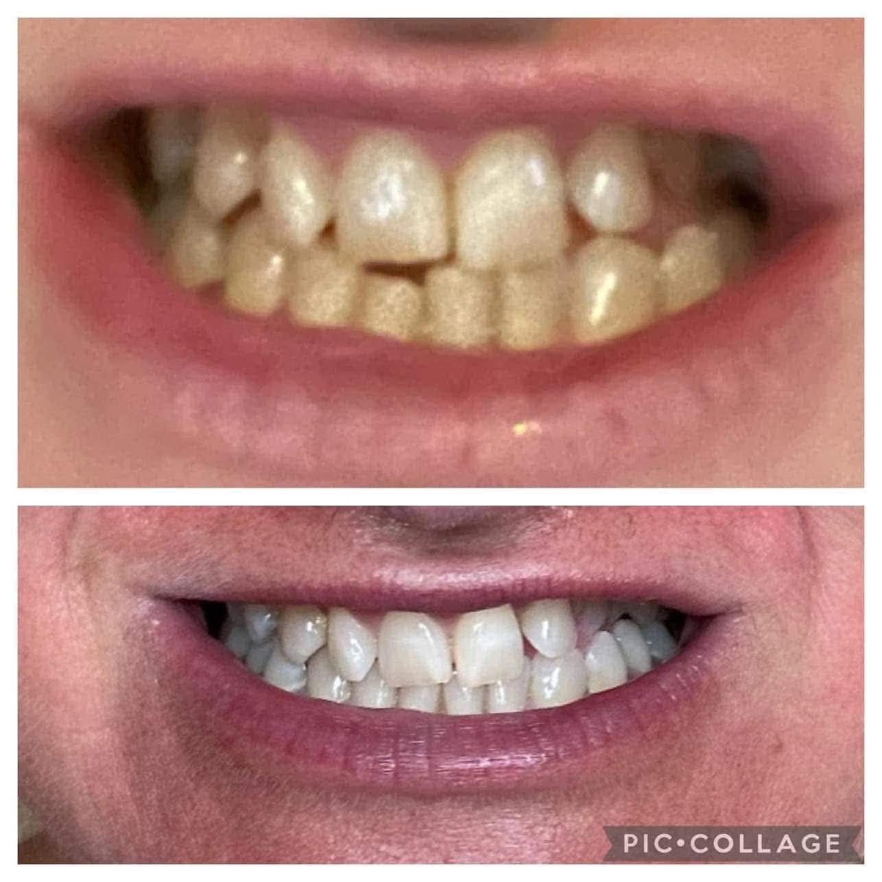 Teeth Whitening – Suitable for Ages 6+